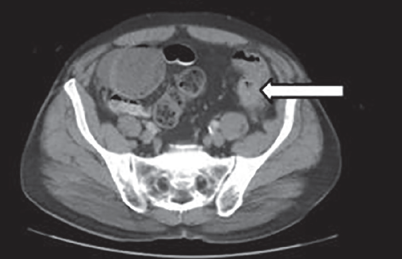Large Bowel Obstruction With Cecal Perforation What’s the Cause